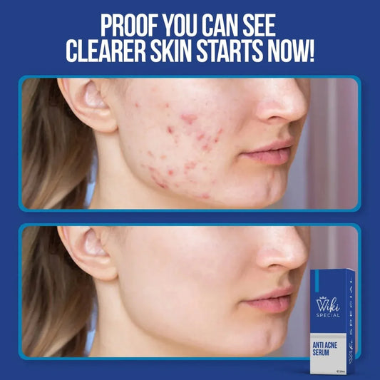 Wiki Special Anti Acne Serum 30ml | Clears Acne & Soothes Skin